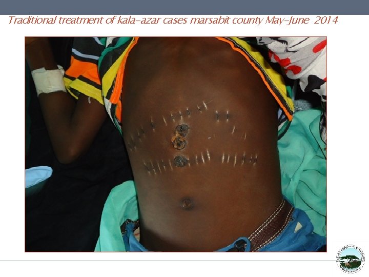 Traditional treatment of kala-azar cases marsabit county May-June 2014 