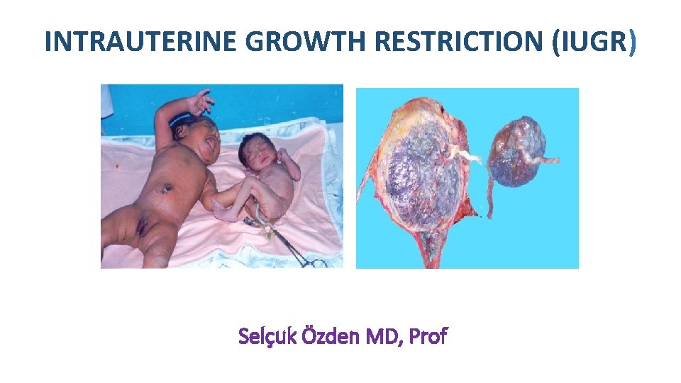 INTRAUTERINE GROWTH RESTRICTION (IUGR) Selçuk Özden MD, Prof 