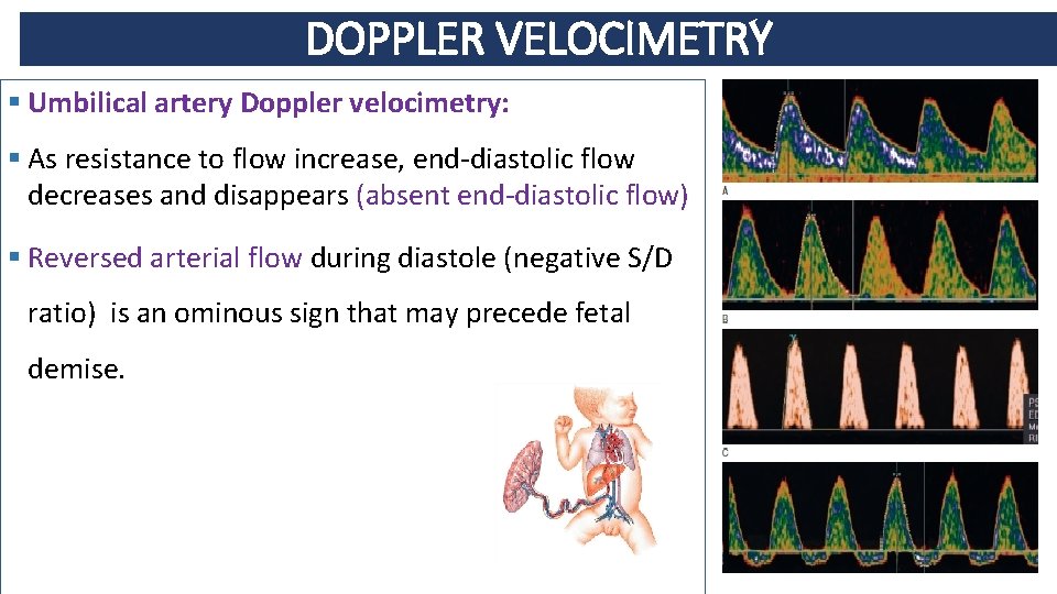 DOPPLER VELOCIMETRY § Umbilical artery Doppler velocimetry: § As resistance to flow increase, end-diastolic