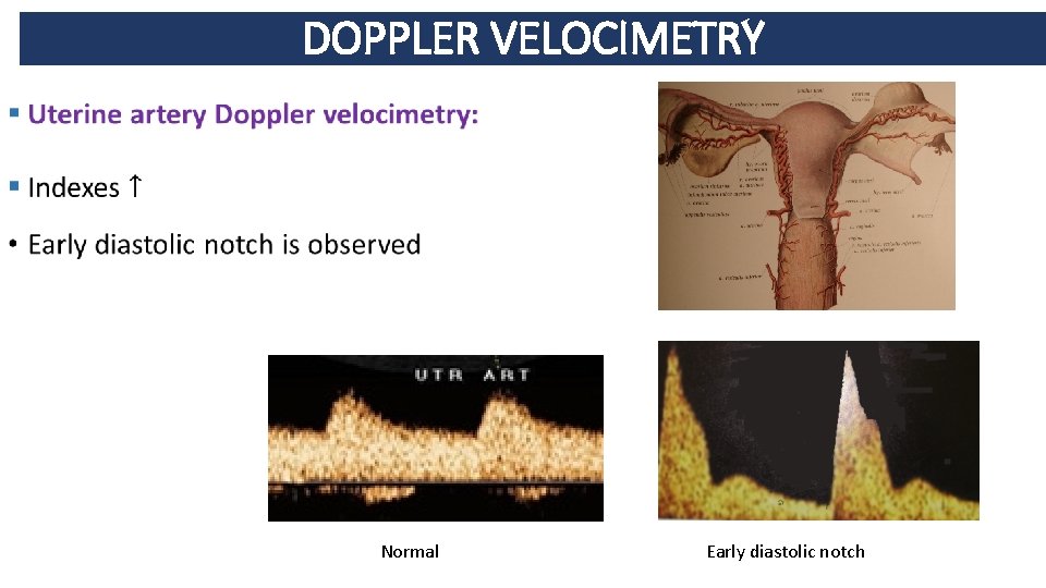 DOPPLER VELOCIMETRY • Normal Early diastolic notch 