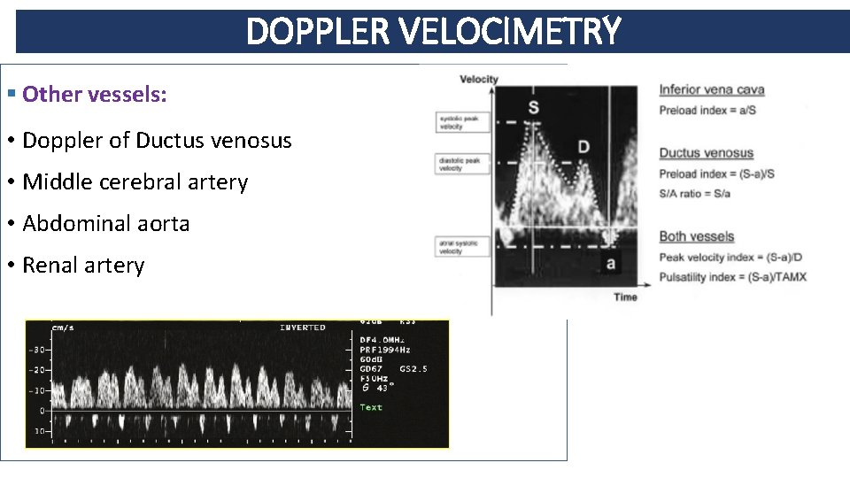 DOPPLER VELOCIMETRY § Other vessels: • Doppler of Ductus venosus • Middle cerebral artery