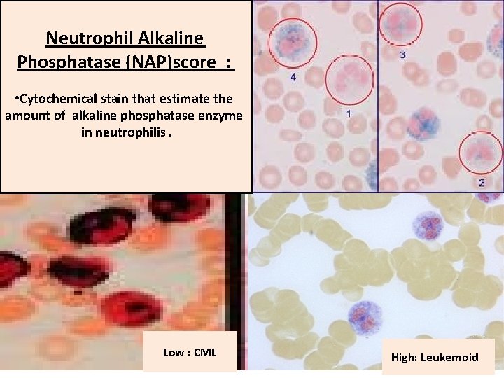 Neutrophil Alkaline Phosphatase (NAP)score : • Cytochemical stain that estimate the amount of alkaline
