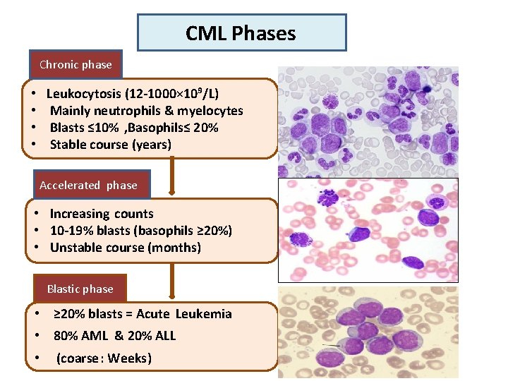 CML Phases Chronic phase • • Leukocytosis (12 -1000× 10⁹/L) Mainly neutrophils & myelocytes