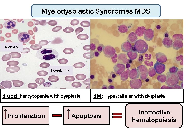 Myelodysplastic Syndromes MDS Normal Dysplastic Blood : Pancytopenia with dysplasia Proliferation BM: Hypercellular with