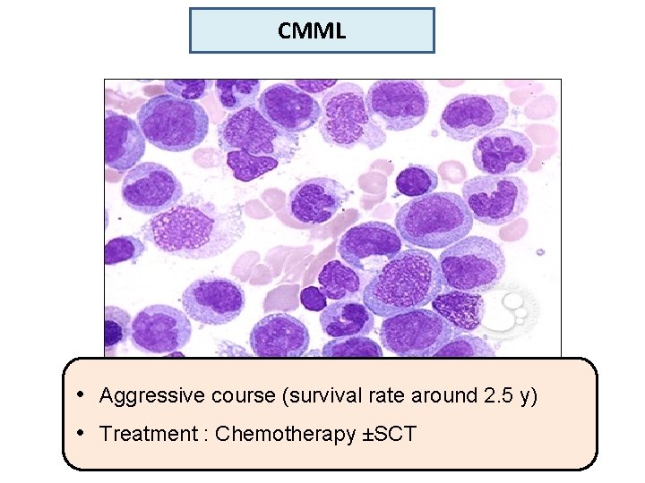 CMML • Aggressive course (survival rate around 2. 5 y) • Treatment : Chemotherapy
