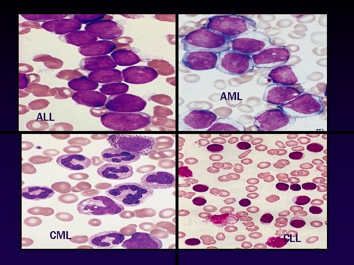 AML ALL CML CLL 4 