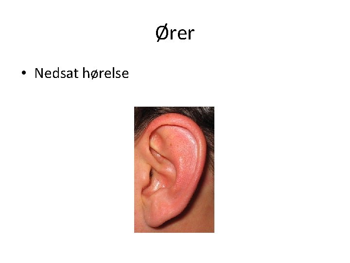 Ører • Nedsat hørelse 