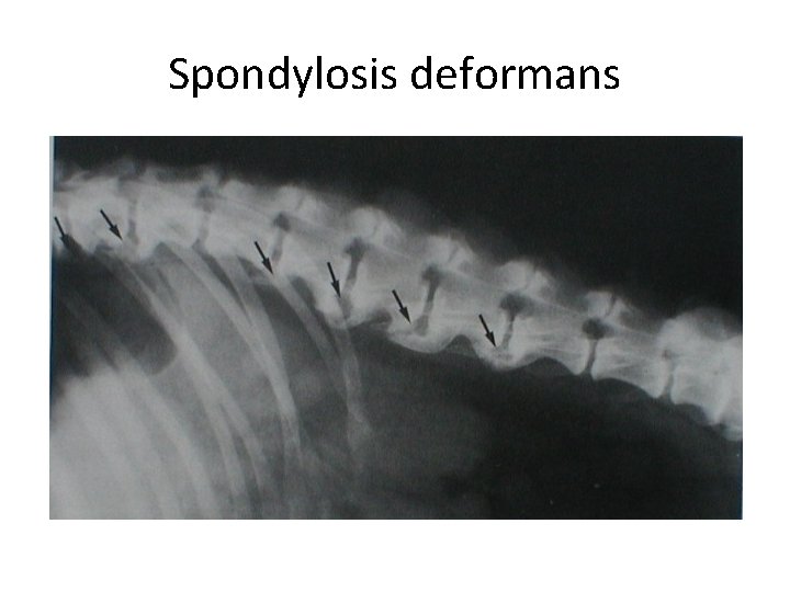 Spondylosis deformans 