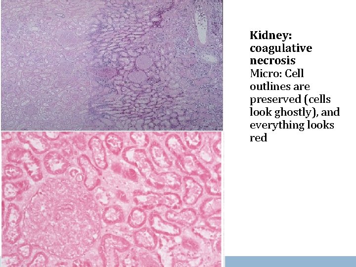 Kidney: coagulative necrosis Micro: Cell outlines are preserved (cells look ghostly), and everything looks