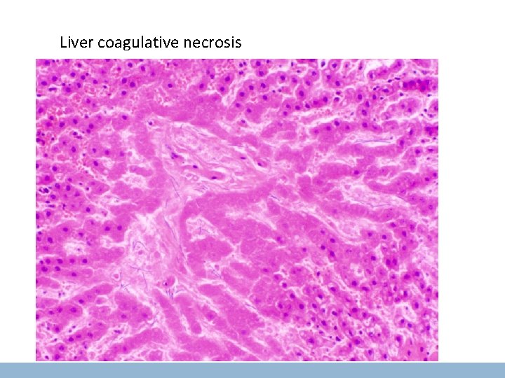 Liver coagulative necrosis 