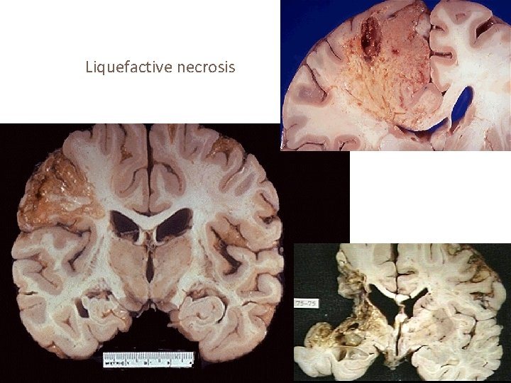 Liquefactive necrosis 