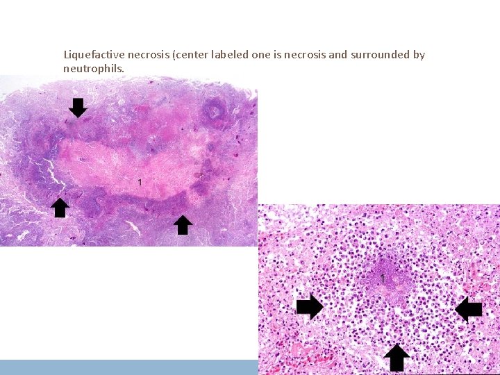 Liquefactive necrosis (center labeled one is necrosis and surrounded by neutrophils. 