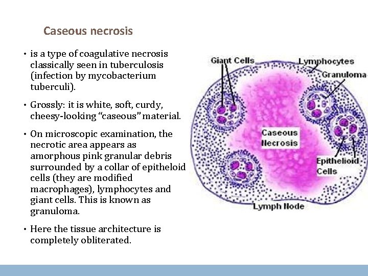 Caseous necrosis • is a type of coagulative necrosis classically seen in tuberculosis (infection