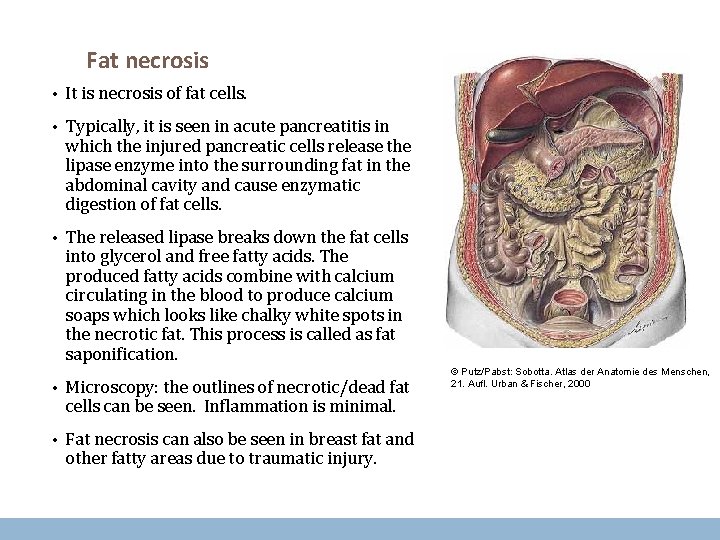 Fat necrosis • It is necrosis of fat cells. • Typically, it is seen