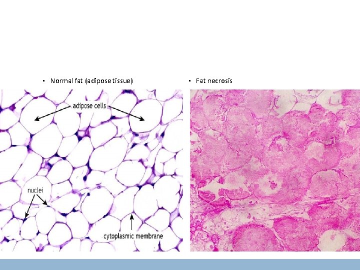  • Normal fat (adipose tissue) • Fat necrosis 