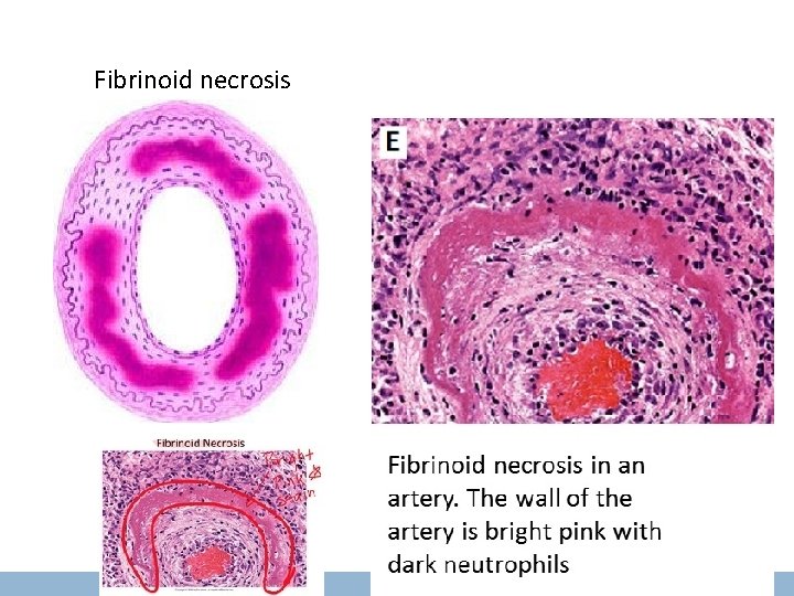 Fibrinoid necrosis 