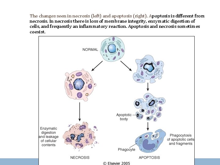 The changes seen in necrosis (left) and apoptosis (right). Apoptosis is different from necrosis.