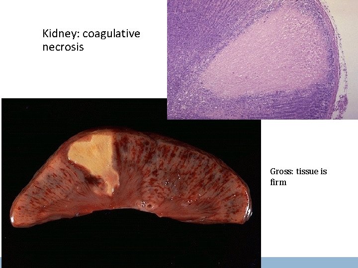 Kidney: coagulative necrosis Gross: tissue is firm 