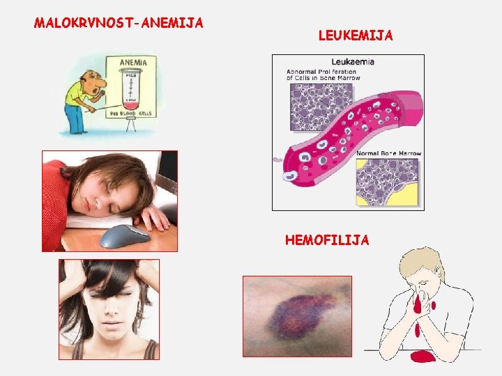 MALOKRVNOST-ANEMIJA LEUKEMIJA HEMOFILIJA 