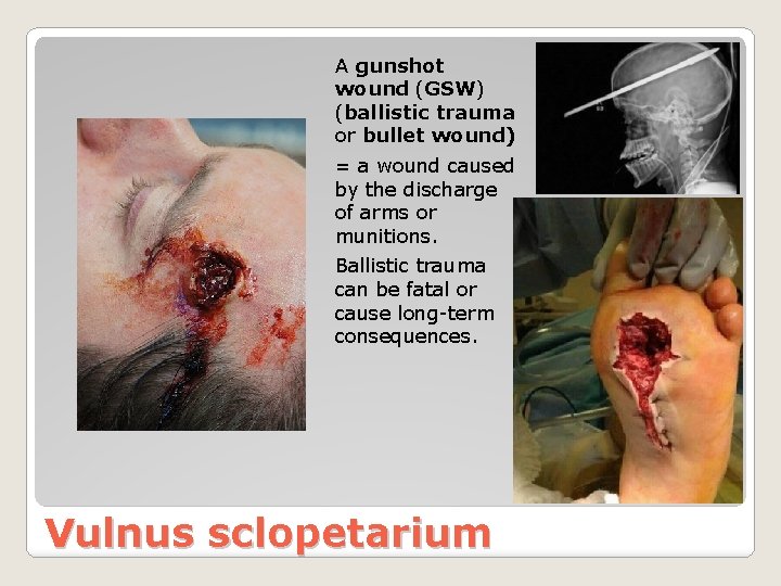 A gunshot wound (GSW) (ballistic trauma or bullet wound) = a wound caused by