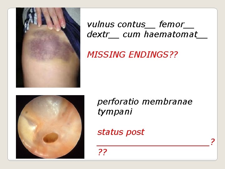 vulnus contus__ femor__ dextr__ cum haematomat__ MISSING ENDINGS? ? perforatio membranae tympani status post