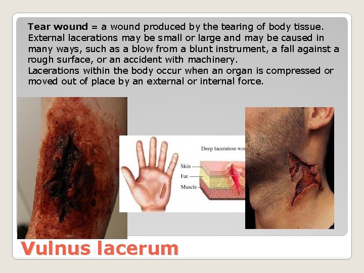 Tear wound = a wound produced by the tearing of body tissue. External lacerations