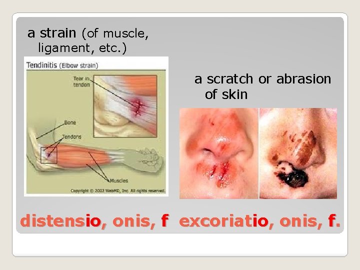 a strain (of muscle, ligament, etc. ) a scratch or abrasion of skin distensio,