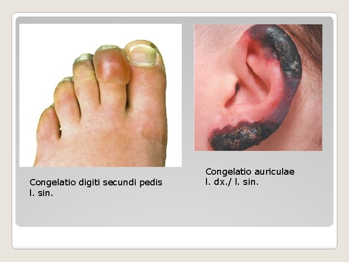 Congelatio digiti secundi pedis l. sin. Congelatio auriculae l. dx. / l. sin. 
