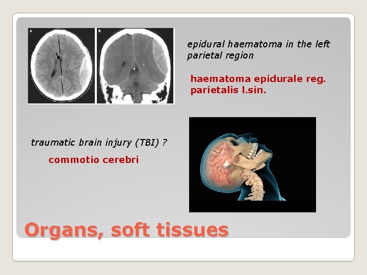 epidural haematoma in the left parietal region haematoma epidurale reg. parietalis l. sin. traumatic