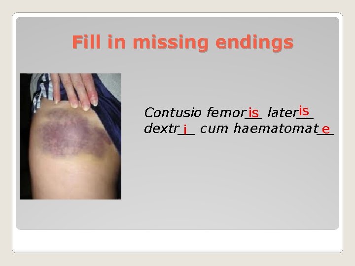 Fill in missing endings is Contusio femor__ is later__ dextr__ e i cum haematomat__