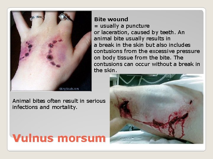 Bite wound = usually a puncture or laceration, caused by teeth. An animal bite