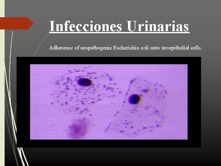 Infecciones Urinarias Adherence of uropathogenic Escherichia coli onto uroepithelial cells. 