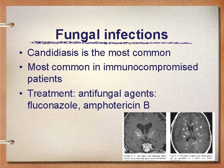 Fungal infections • Candidiasis is the most common • Most common in immunocompromised patients