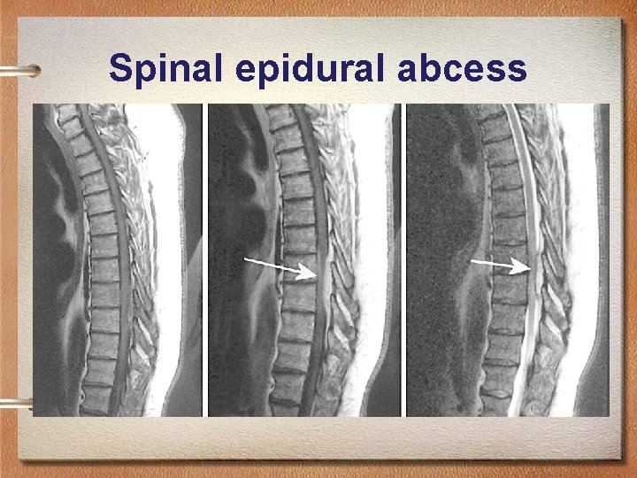 Spinal epidural abcess 