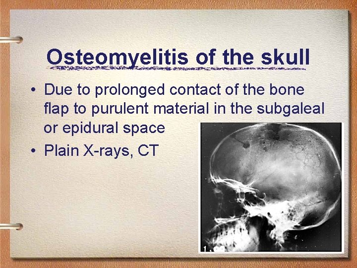 Osteomyelitis of the skull • Due to prolonged contact of the bone flap to