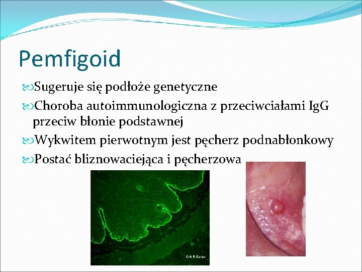 Pemfigoid Sugeruje się podłoże genetyczne Choroba autoimmunologiczna z przeciwciałami Ig. G przeciw błonie podstawnej