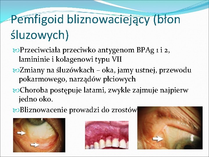 Pemfigoid bliznowaciejący (błon śluzowych) Przeciwciała przeciwko antygenom BPAg 1 i 2, lamininie i kolagenowi