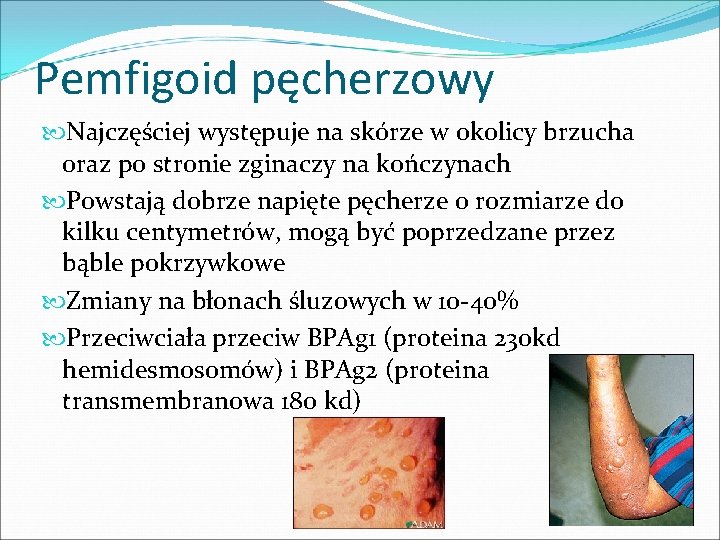 Pemfigoid pęcherzowy Najczęściej występuje na skórze w okolicy brzucha oraz po stronie zginaczy na