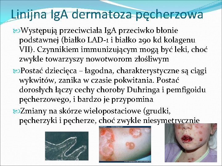 Linijna Ig. A dermatoza pęcherzowa Występują przeciwciała Ig. A przeciwko błonie podstawnej (białko LAD-1