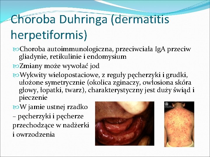 Choroba Duhringa (dermatitis herpetiformis) Choroba autoimmunologiczna, przeciwciała Ig. A przeciw gliadynie, retikulinie i endomysium