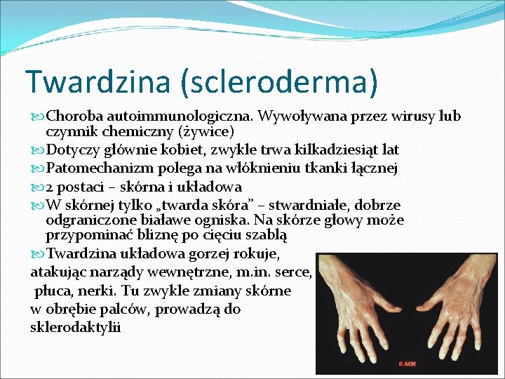 Twardzina (scleroderma) Choroba autoimmunologiczna. Wywoływana przez wirusy lub czynnik chemiczny (żywice) Dotyczy głównie kobiet,