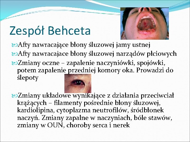 Zespół Behceta Afty nawracające błony śluzowej jamy ustnej Afty nawracajace błony śluzowej narządów płciowych