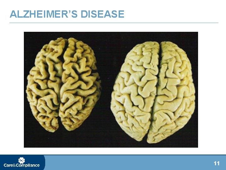 ALZHEIMER’S DISEASE 11 