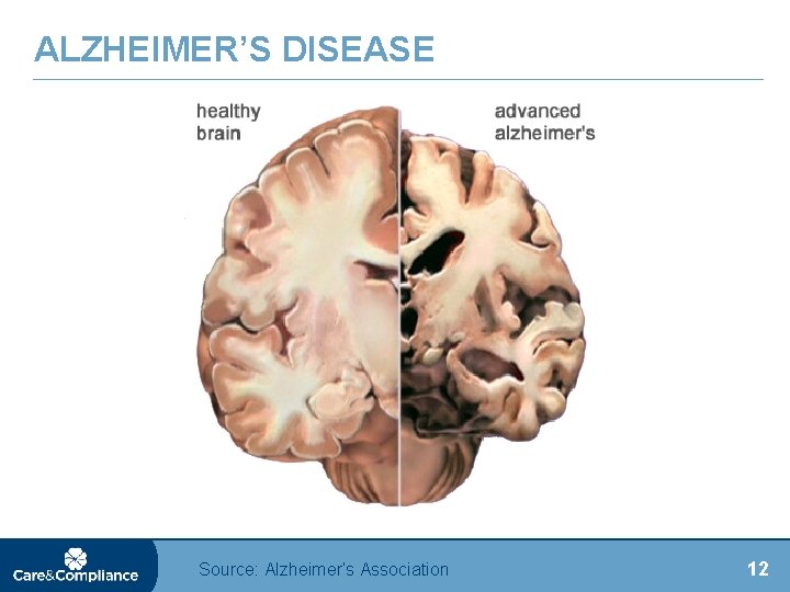 ALZHEIMER’S DISEASE Source: Alzheimer’s Association 12 