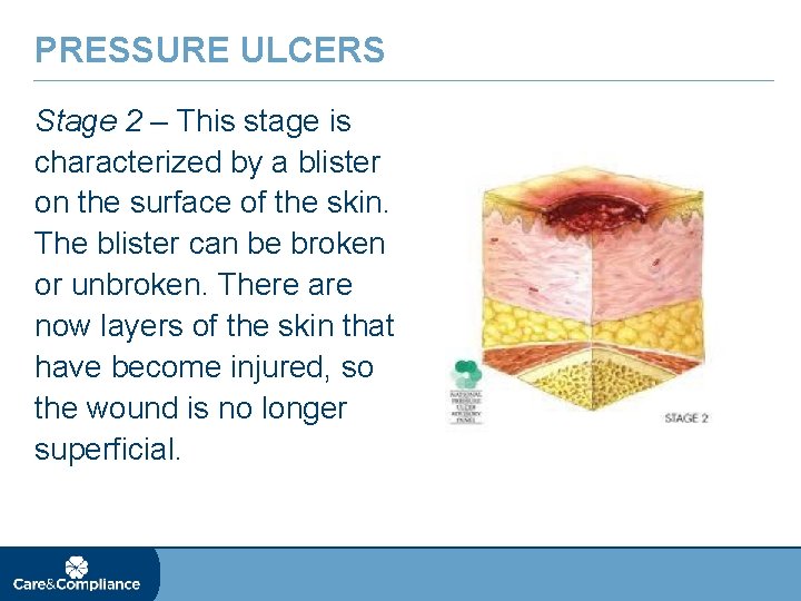 PRESSURE ULCERS Stage 2 – This stage is characterized by a blister on the