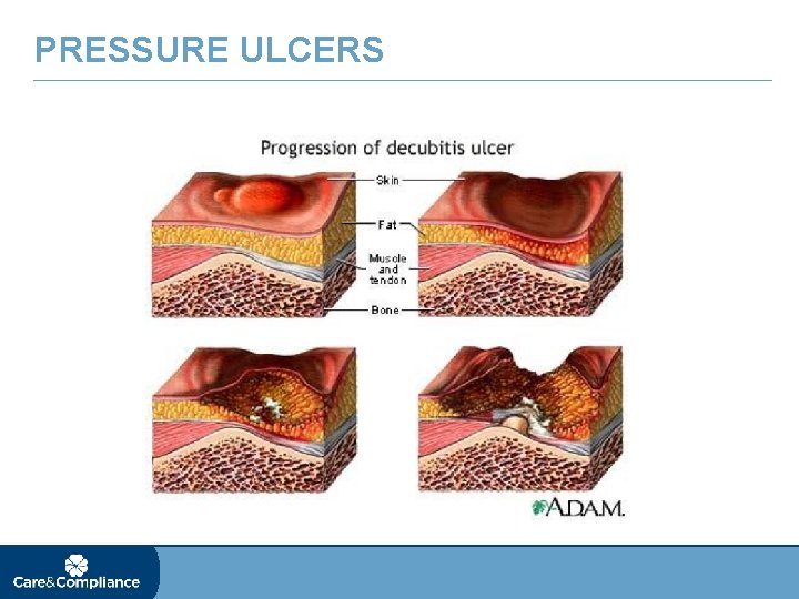 PRESSURE ULCERS 