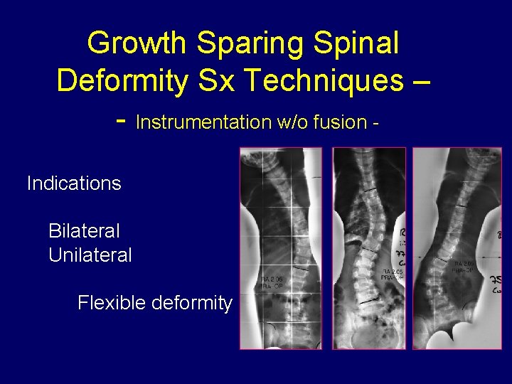 Growth Sparing Spinal Deformity Sx Techniques – - Instrumentation w/o fusion - Indications Bilateral