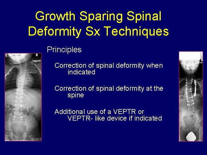 Growth Sparing Spinal Deformity Sx Techniques Principles Correction of spinal deformity when indicated Correction