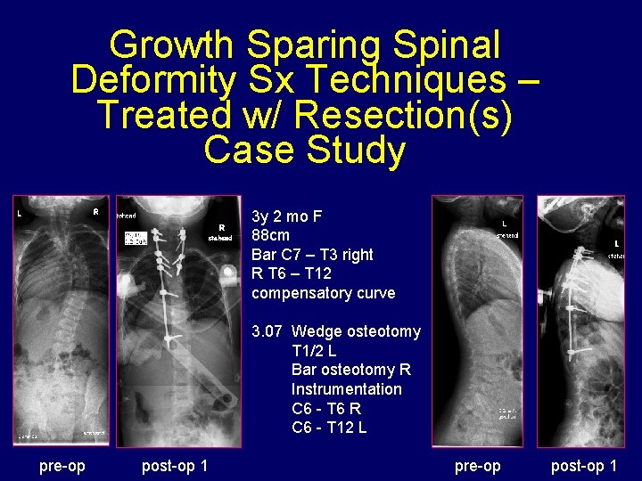 Growth Sparing Spinal Deformity Sx Techniques – Treated w/ Resection(s) Case Study 3 y
