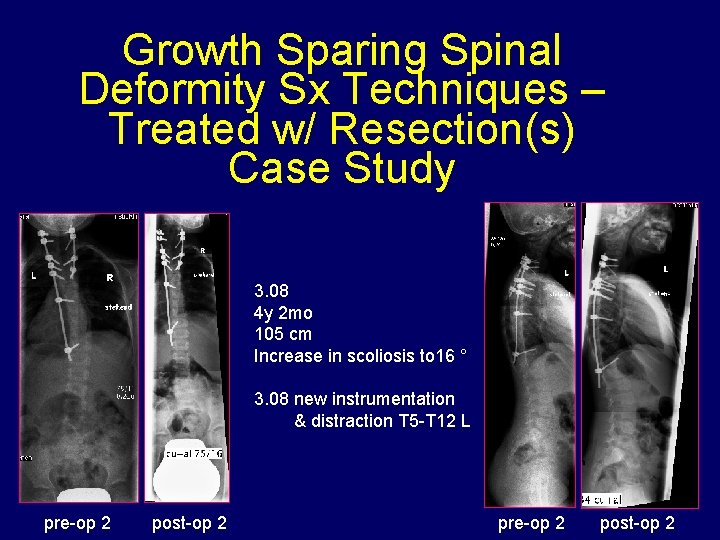 Growth Sparing Spinal Deformity Sx Techniques – Treated w/ Resection(s) Case Study 3. 08